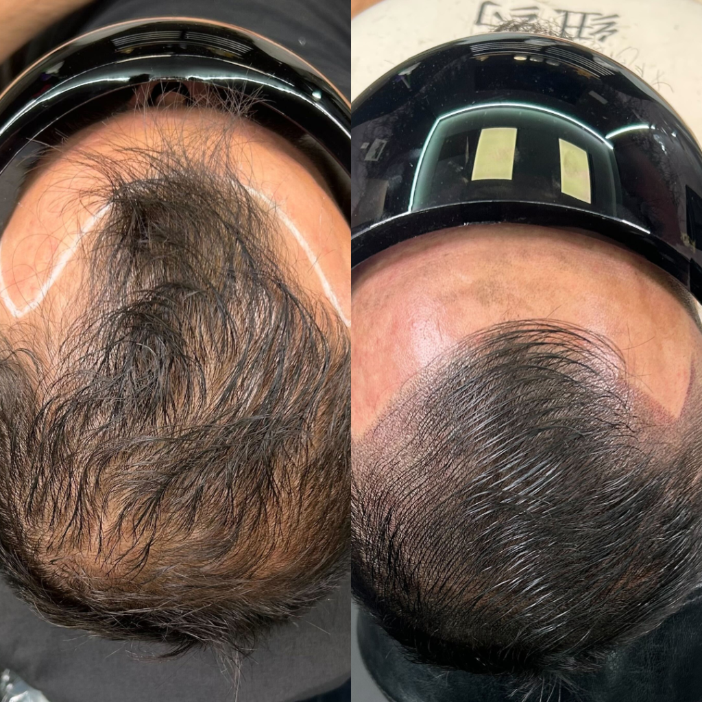 thinning hair